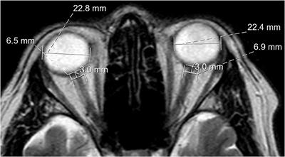 Signs of Intracranial Hypertension, Hypermobility, and Craniocervical Obstructions in Patients With Myalgic Encephalomyelitis/Chronic Fatigue Syndrome